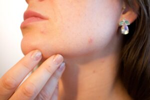 毛穴開き改善に効果的なスキンケア方法は？